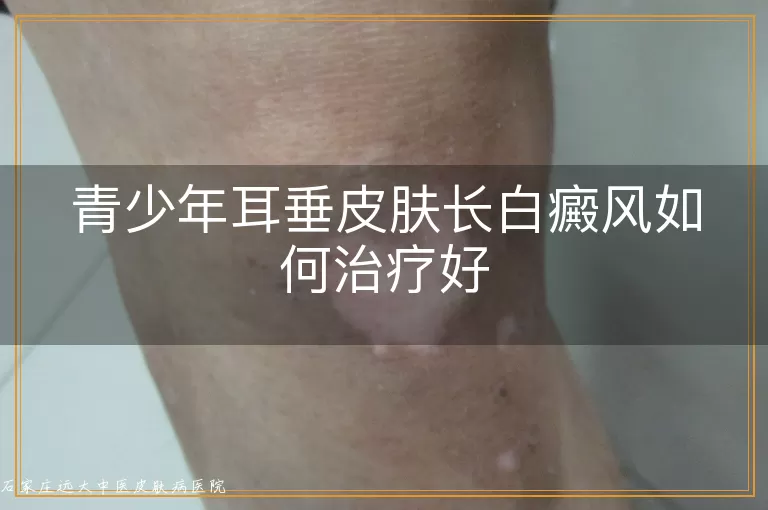青少年耳垂皮肤长白癜风如何治疗好