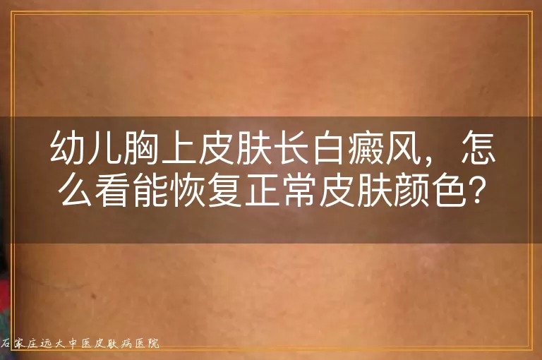 幼儿胸上皮肤长白癜风，怎么看能恢复正常皮肤颜色？
