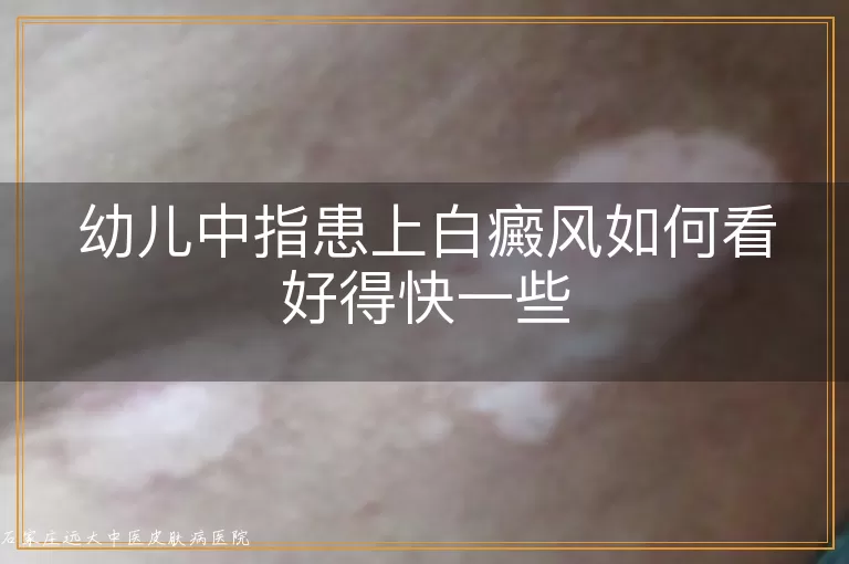 幼儿中指患上白癜风如何看好得快一些