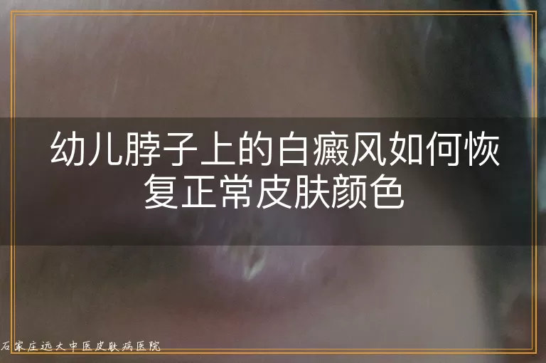 幼儿脖子上的白癜风如何恢复正常皮肤颜色