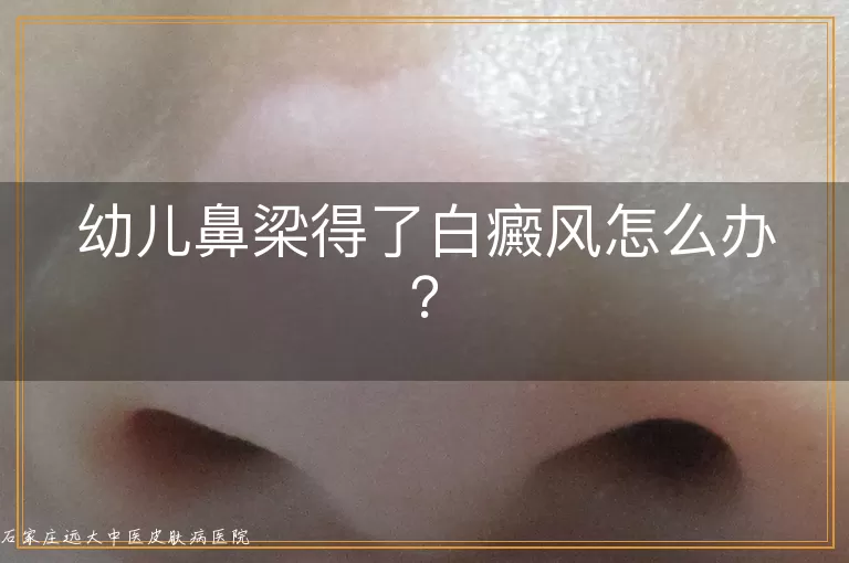 幼儿鼻梁得了白癜风怎么办？