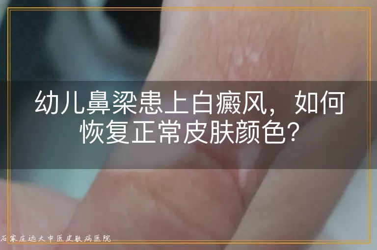 幼儿鼻梁患上白癜风，如何恢复正常皮肤颜色？
