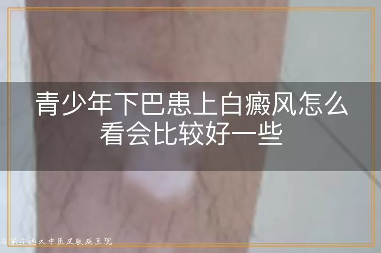 青少年下巴患上白癜风怎么看会比较好一些