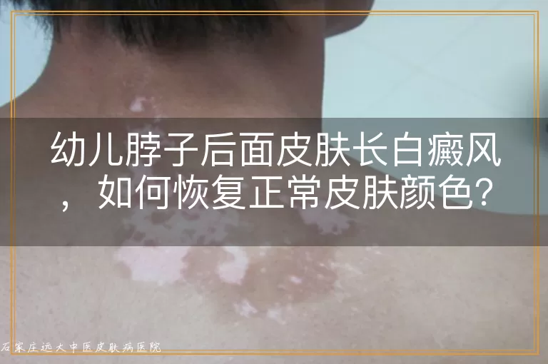 幼儿脖子后面皮肤长白癜风，如何恢复正常皮肤颜色？