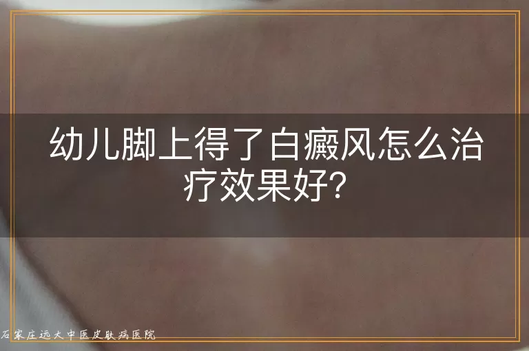 幼儿脚上得了白癜风怎么治疗效果好?