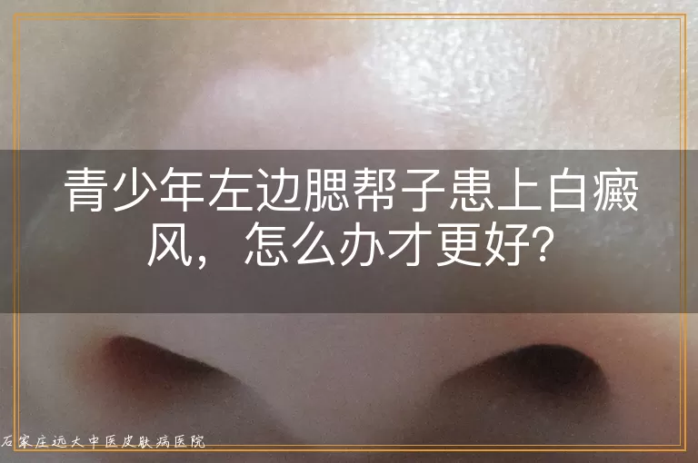 青少年左边腮帮子患上白癜风，怎么办才更好？