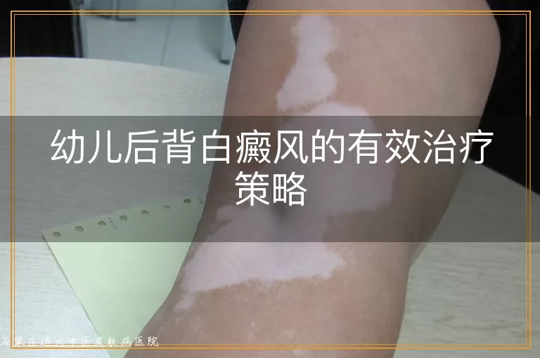 幼儿后背白癜风的有效治疗策略