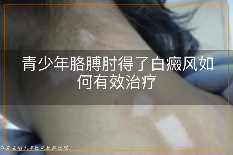 青少年胳膊肘得了白癜风如何有效治疗
