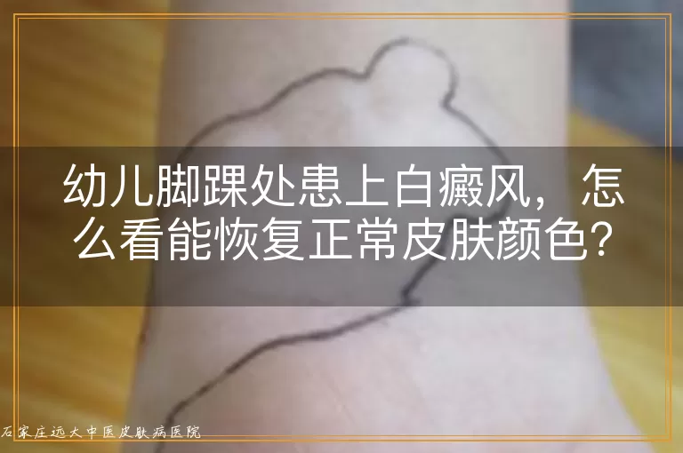 幼儿脚踝处患上白癜风,怎么看能恢复正常皮肤颜色?