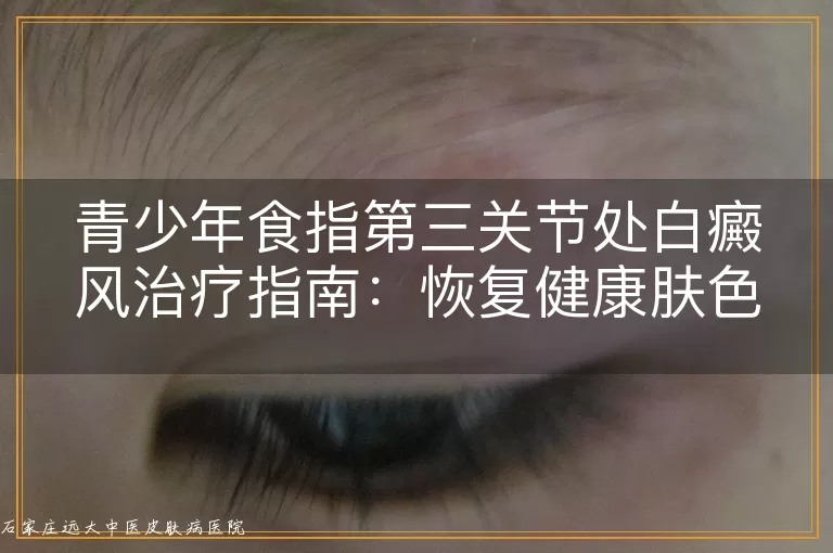 青少年食指第三关节处白癜风治疗指南：恢复健康肤色的方法