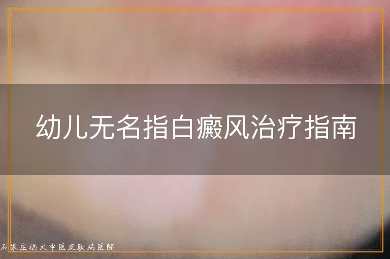 幼儿无名指白癜风治疗指南