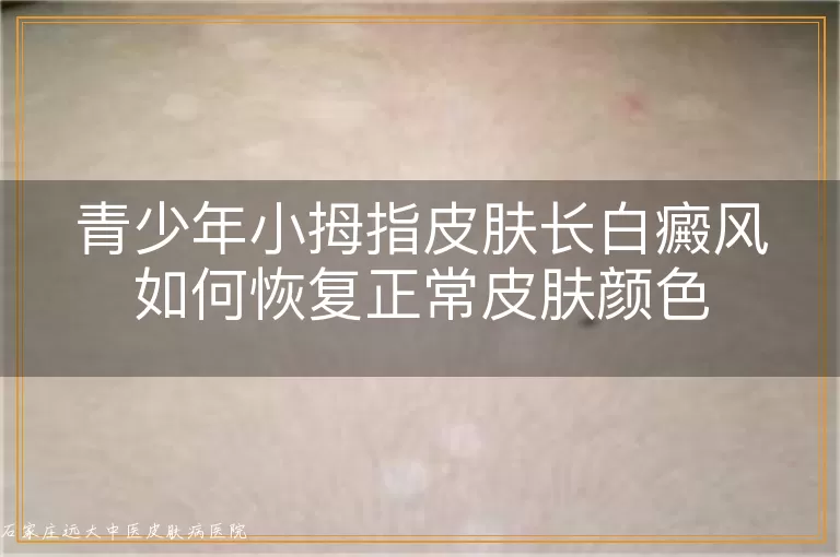 青少年小拇指皮肤长白癜风如何恢复正常皮肤颜色