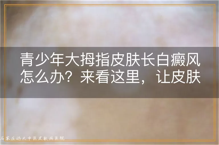 青少年大拇指皮肤长白癜风怎么办？来看这里，让皮肤颜色恢复正常不再是梦！