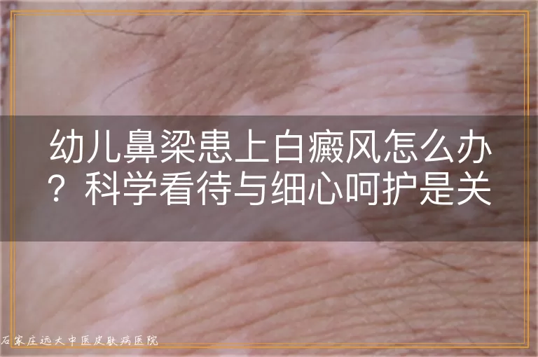 幼儿鼻梁患上白癜风怎么办？科学看待与细心呵护是关键