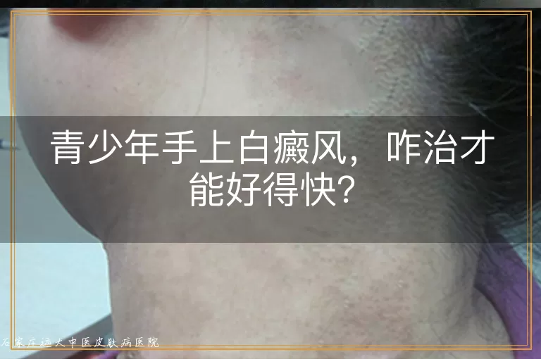 青少年手上白癜风，咋治才能好得快？