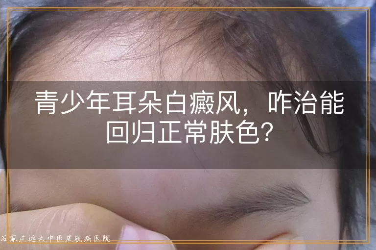 青少年耳朵白癜风，咋治能回归正常肤色？