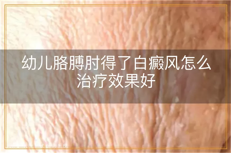 幼儿胳膊肘得了白癜风怎么治疗效果好