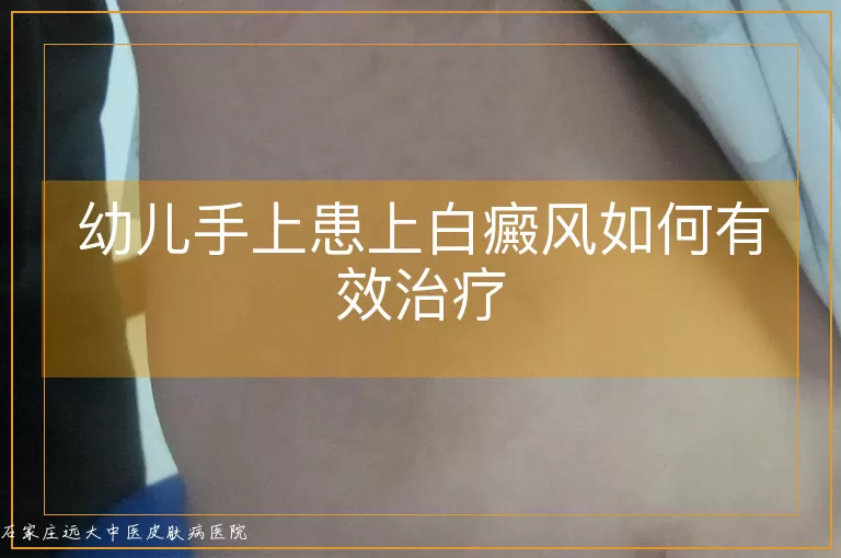 幼儿手上患上白癜风如何有效治疗