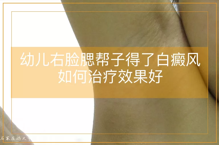 幼儿右脸腮帮子得了白癜风如何治疗效果好