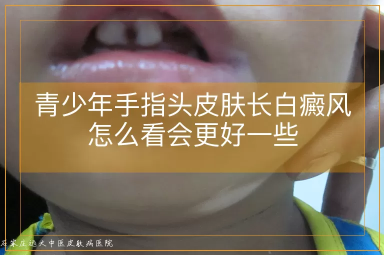 青少年手指头皮肤长白癜风怎么看会更好一些
