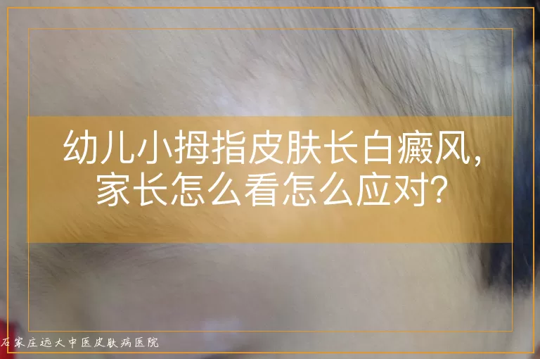 幼儿小拇指皮肤长白癜风，家长怎么看怎么应对？
