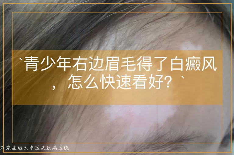 青少年右边眉毛得了白癜风，怎么快速看好？