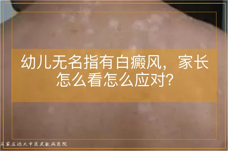 幼儿无名指有白癜风，家长怎么看怎么应对？