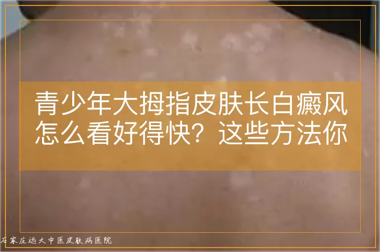 青少年大拇指皮肤长白癜风怎么看好得快？这些方法你得知道！