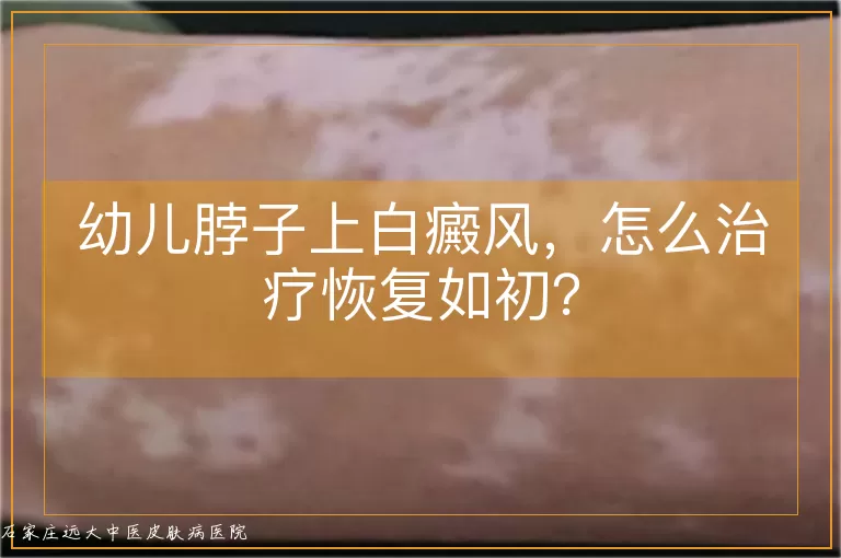 幼儿脖子上白癜风，怎么治疗恢复如初？