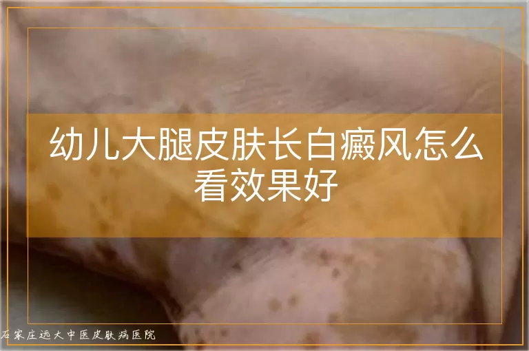 幼儿大腿皮肤长白癜风怎么看效果好