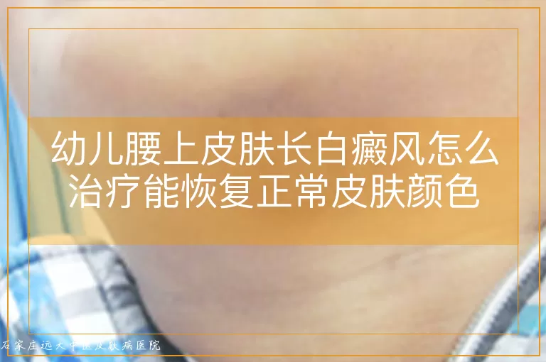 幼儿腰上皮肤长白癜风怎么治疗能恢复正常皮肤颜色