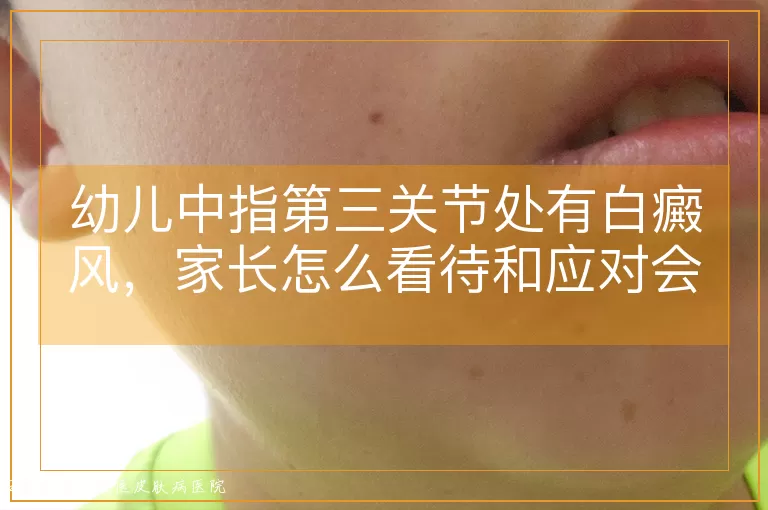 幼儿中指第三关节处有白癜风，家长怎么看待和应对会更好？