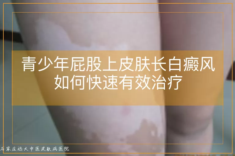 青少年屁股上皮肤长白癜风如何快速有效治疗