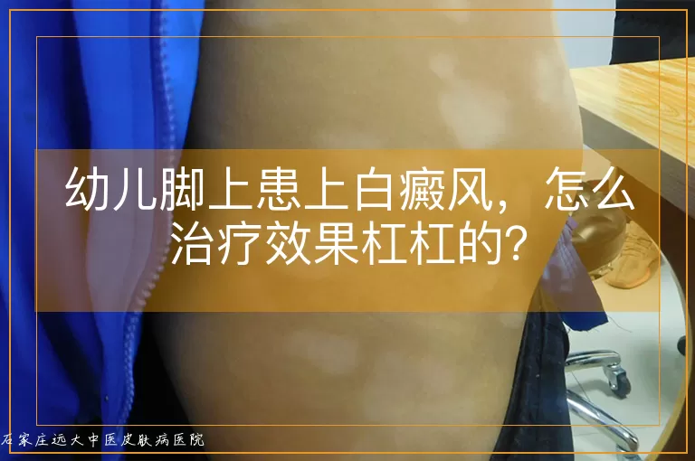 幼儿脚上患上白癜风，怎么治疗效果杠杠的？
