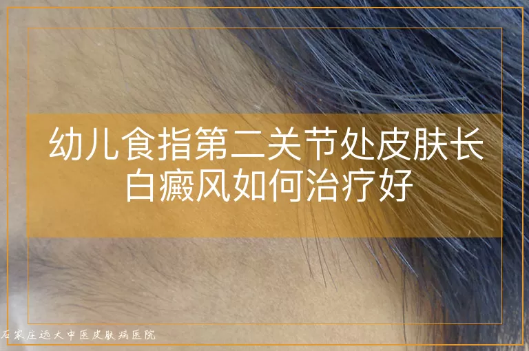 幼儿食指第二关节处皮肤长白癜风如何治疗好