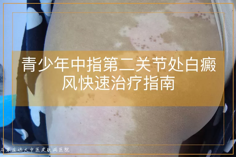 青少年中指第二关节处白癜风快速治疗指南