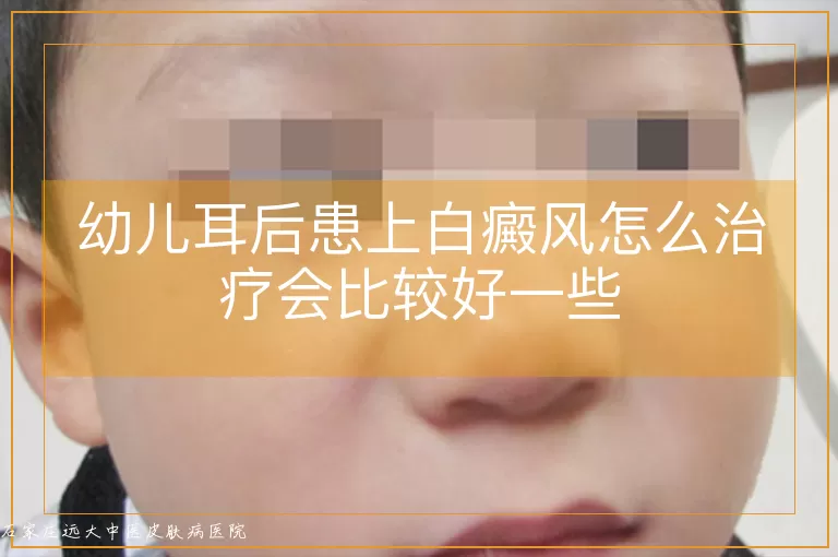 幼儿耳后患上白癜风怎么治疗会比较好一些