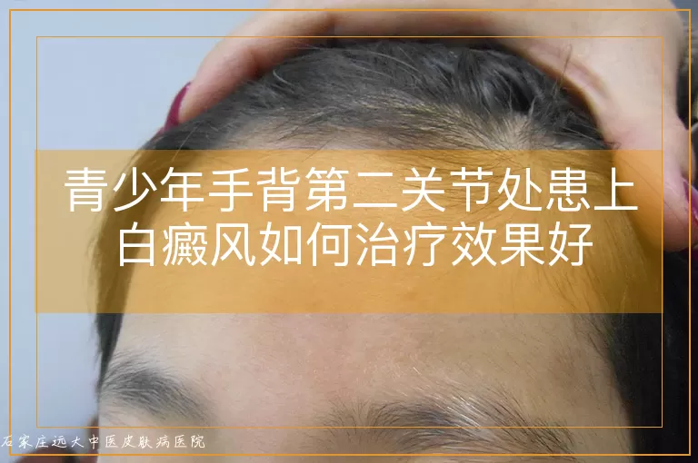 青少年手背第二关节处患上白癜风如何治疗效果好