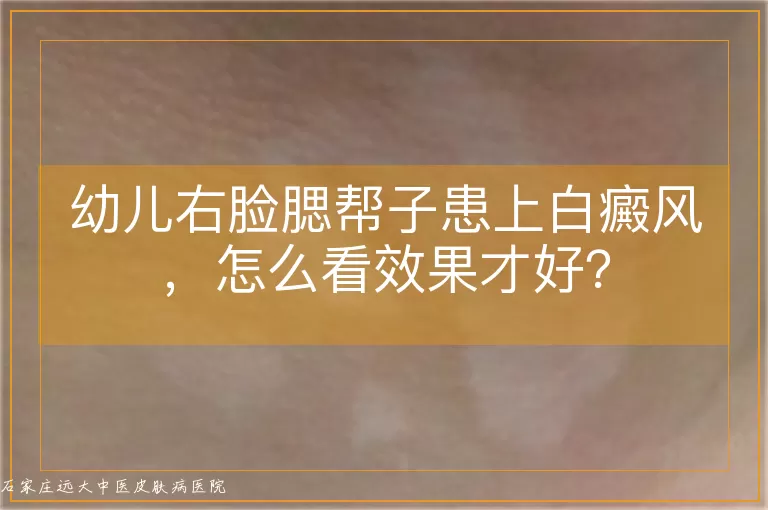 幼儿右脸腮帮子患上白癜风，怎么看效果才好？