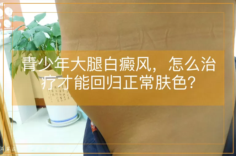 青少年大腿白癜风，怎么治疗才能回归正常肤色？