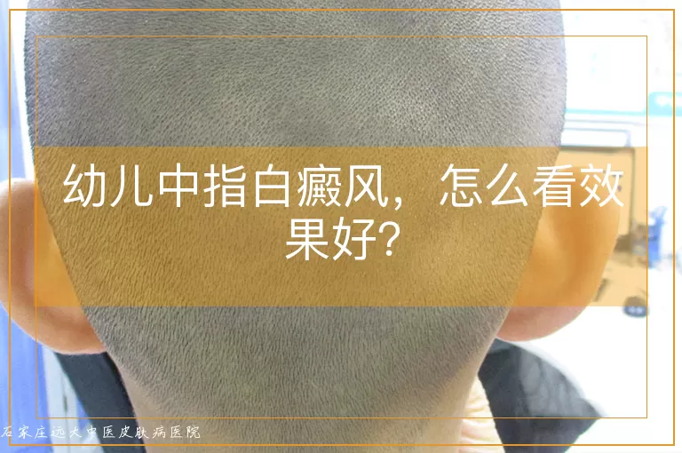 幼儿中指白癜风，怎么看效果好？