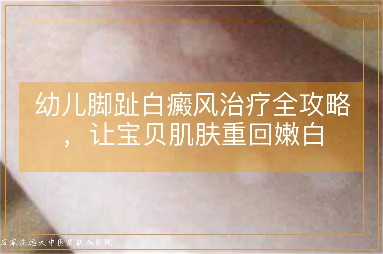 幼儿脚趾白癜风治疗全攻略，让宝贝肌肤重回嫩白