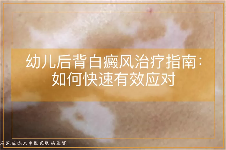 幼儿后背白癜风治疗指南：如何快速有效应对