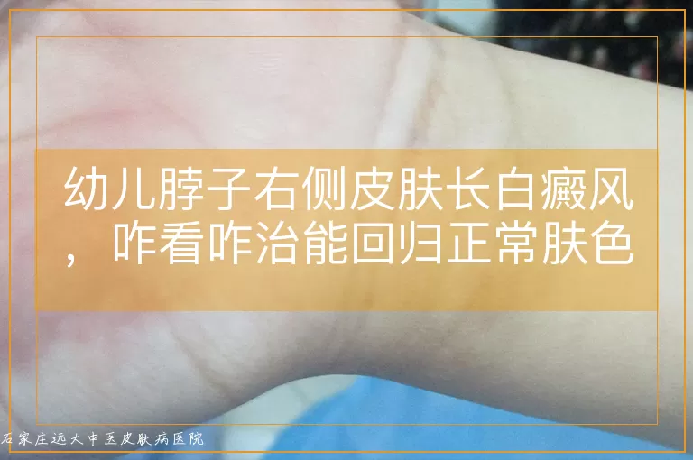 幼儿脖子右侧皮肤长白癜风，咋看咋治能回归正常肤色？