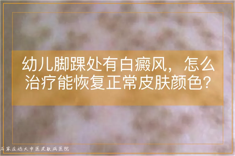 幼儿脚踝处有白癜风，怎么治疗能恢复正常皮肤颜色？