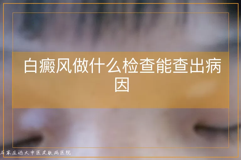 白癜风做什么检查能查出病因