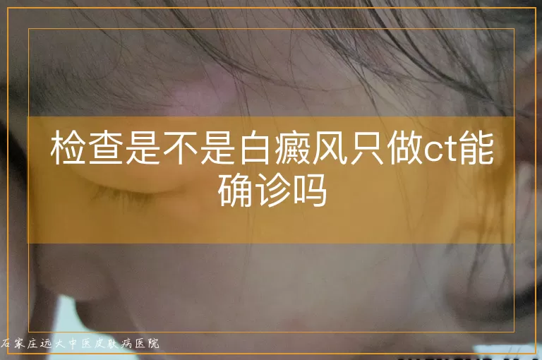 检查是不是白癜风只做ct能确诊吗