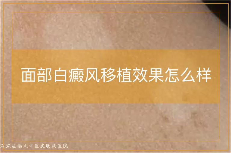 面部白癜风移植效果怎么样