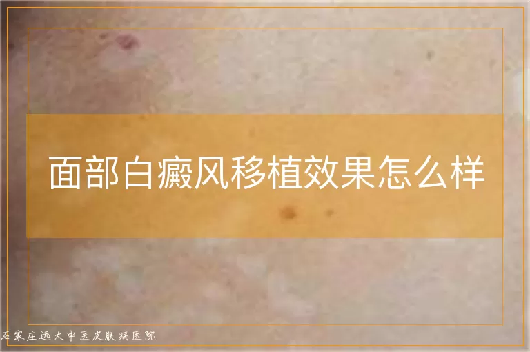 面部白癜风移植效果怎么样