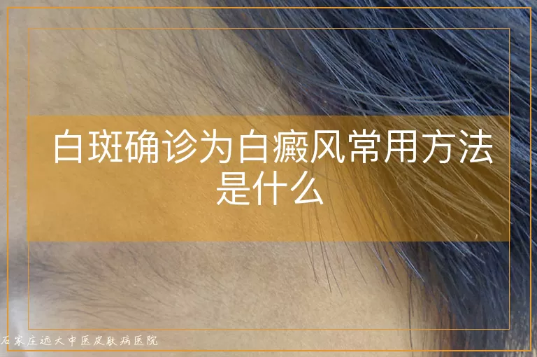 白斑确诊为白癜风常用方法是什么